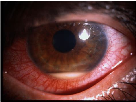 Diagnosis and classification of autoimmune uveitis. | Semantic Scholar