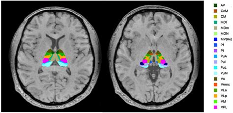 Thalamus Anatomy Mri