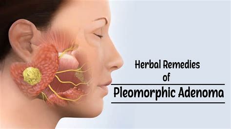 Herbal Treatment of Pleomorphic Adenomas - Symptoms, Diagnosis ...