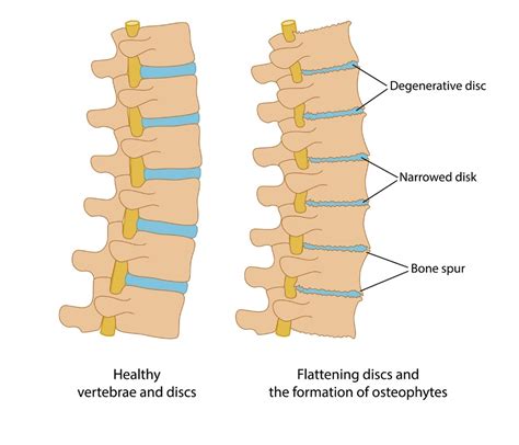 Cervical Disc Disorder