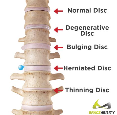 Bulging Disc | Bulging disc, Herniated disc