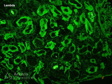 Light Chain Deposition Disease | Teaching Points | Arkana Laboratories