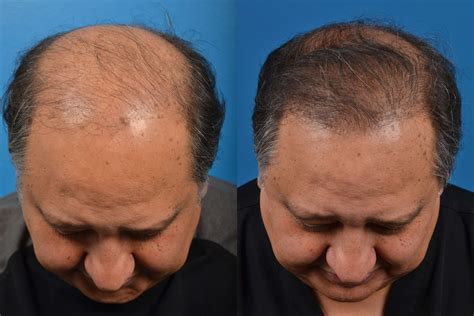 Hair Restoration Photos | Melbourne, FL | Patient 16955