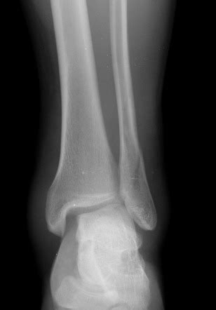 Distal tibia fibula fracture - kopolkiwi