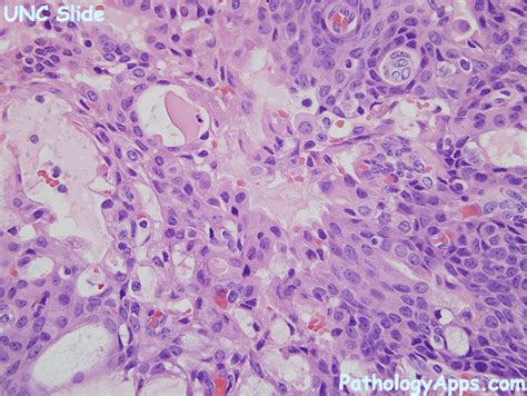 mucoepidermoid carcinoma pathology