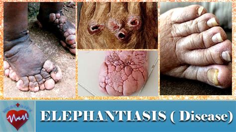 Elephantiasis Disease Causes, Symptoms And Elephantiasis, 42% OFF