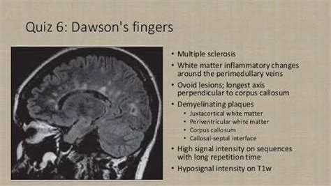 Dawson's Fingers|MRI|MultipleSclerosis | White matter, Corpus callosum ...