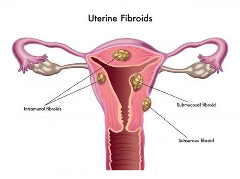 Avances en el tratamiento de los miomas uterinos - Cachicha.com