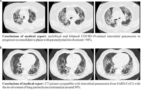 CT lung scan pictures of two randomly chosen COVID-19 patients (a and ...