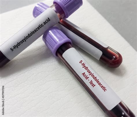 Blood sample for 5-HIAA (5-Hydroxyindoleacetic acid) test, used to help ...