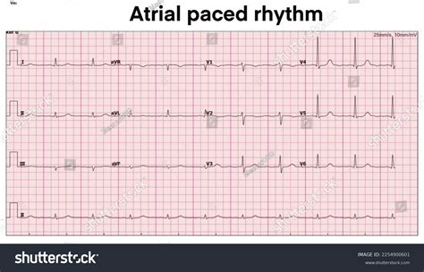 Electrocardiogram Show Atrial Paced Rhythm Cardiac Stock Illustration ...