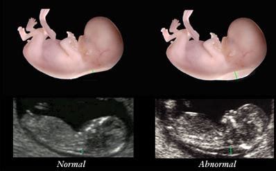 Nuchal Translucency - Test, Ultrasound, Normal Range, Results