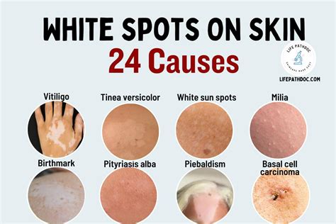 White Spots on Skin: 24 Causes, Pictures, Treatment