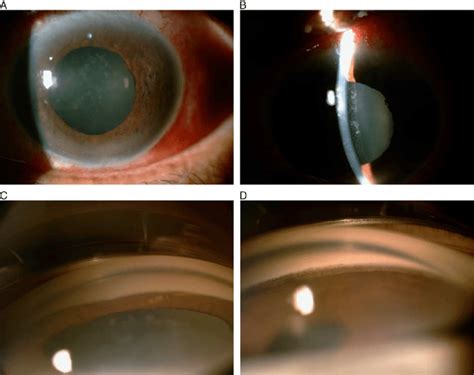 Gonioscopy Narrow Angle