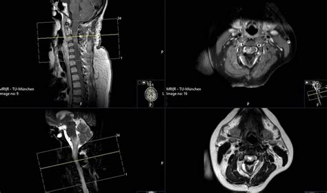 T1-MRI scan with contrast enhancement (upper image) and T2-MRI scan ...