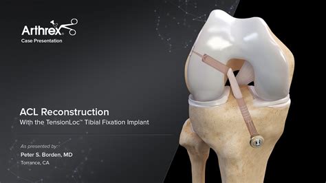 Arthrex - Transtibial™ ACL Reconstruction