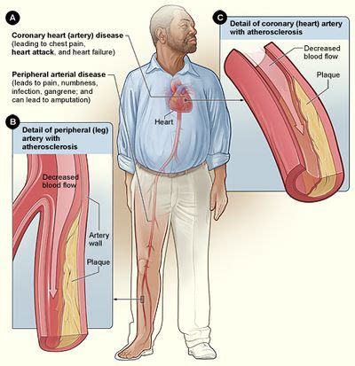 How To Diagnose Atherosclerosis - Animalrepair25