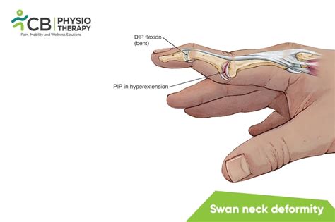 What is Swan Neck Deformity? Symptoms, Causes, Diagnosis ...