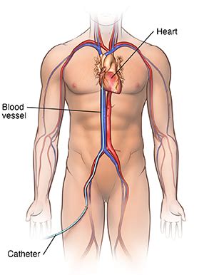 Cardiac Catheterization | University Hospitals