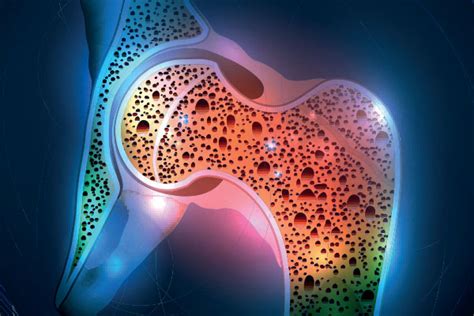 Metabolic Bone Disease and Calcium Disorder - Asheville Endocrinology ...