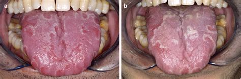 Diseases of the Tongue | Pocket Dentistry