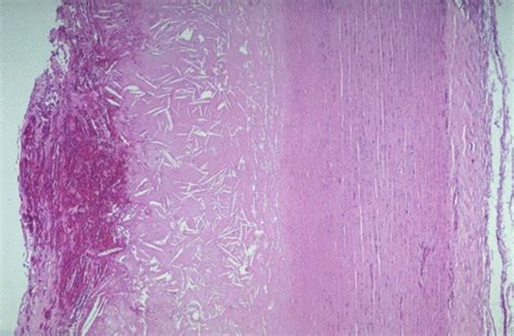 Cardiovascular Pathology