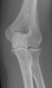 Distal Humerus Fracture | Orthopaedic Trauma Association (OTA)