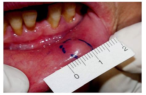 Notes on Mucocele and Mucous Retention cyst-Etiology,Clinical Features ...