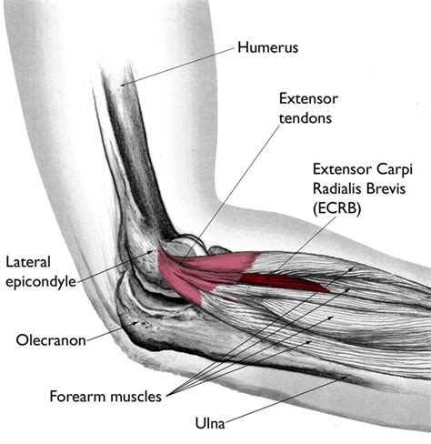 Tennis Elbow (Lateral Epicondylitis) - OrthoInfo - AAOS