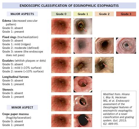 Upper Endoscopy Egd Youtube