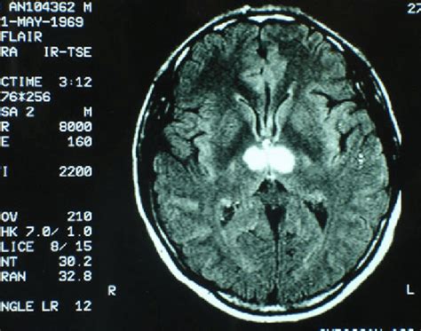 Bilateral thalamic infarction involving the medial group of thalamic ...