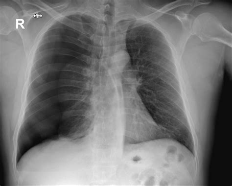 Pneumothorax Chest X Ray