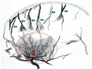 Moyamoya Disease - Nashville Neurosurgery Associates