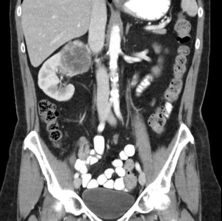 Renal Cell Carcinoma CT Scan