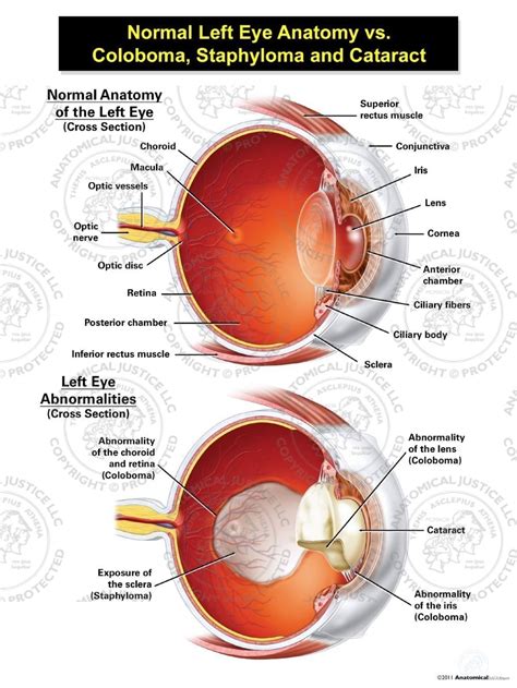 Normal Left Eye Anatomy Coloboma, Staphyloma, And Cataract | lupon.gov.ph