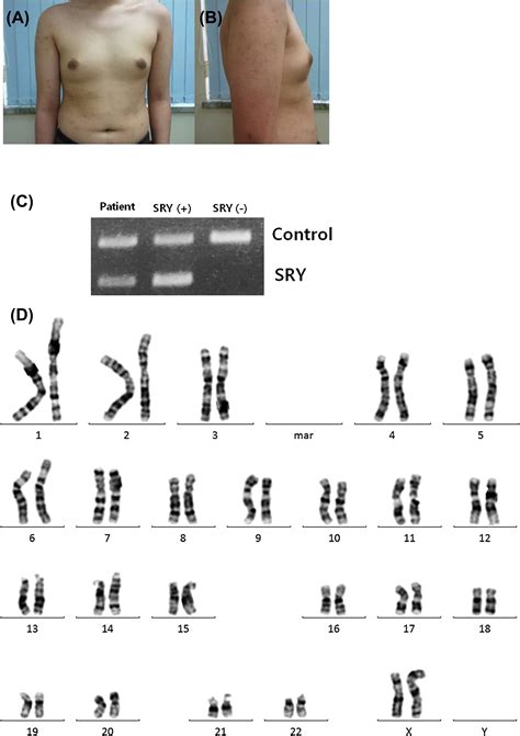 References in A 46,XX Male Adolescent Presenting with a Chief Complaint ...