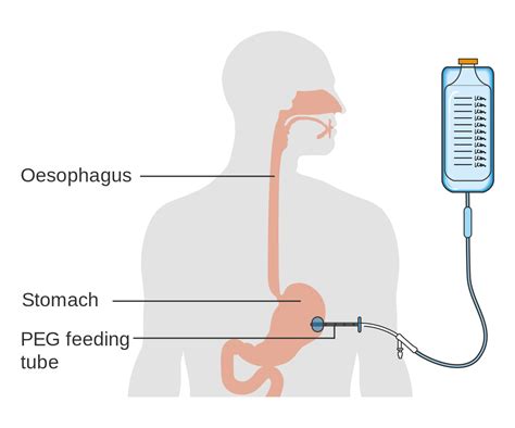 HOME TUBING- PEG tube TRACH tube, can Families Cope? | Enayati