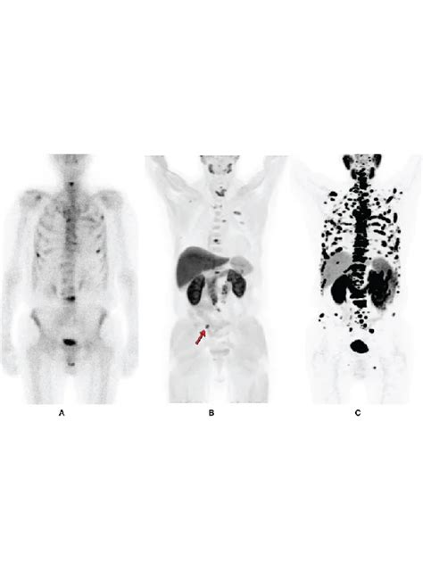 Nueclear | F18 PSMA PET Scan | Prostate Imaging Cancer | Nueclear