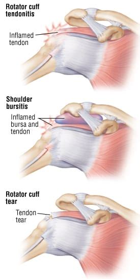 Patient Basics: Rotator Cuff Injury | 2 Minute Medicine