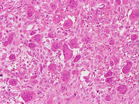 Giant Cell Tumor Histology