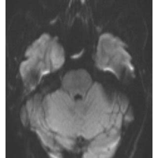 Imaging of patient 1. (a) Preoperative contrast-enhanced axial T1 MRI ...