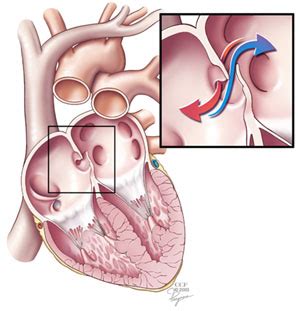 My Brain. My Heart. Figuratively. Literally.: What is a Patent Foramen ...