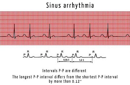 Respiratory Sinus Arrhythmia