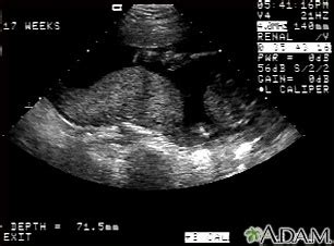 Ultrasound, normal placenta - Braxton Hicks: MedlinePlus Medical ...