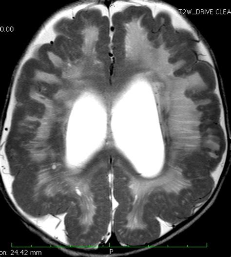 Cobblestone lissencephaly-MRI - Sumer's Radiology Blog