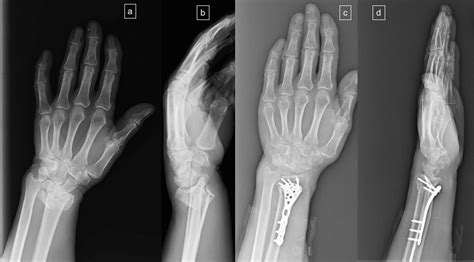 Cureus | Clinical Results of Distal Radius Intraarticular Comminuted ...