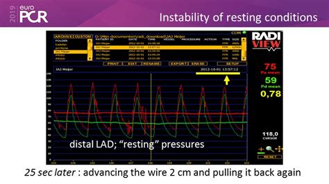 Simplifying your FFR procedure