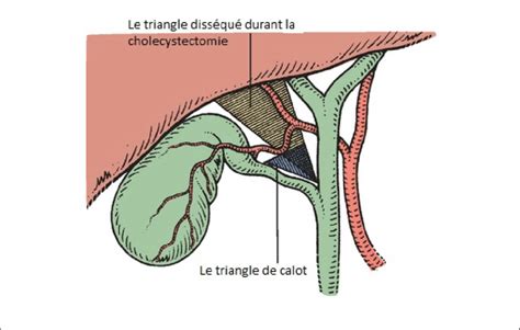 le triangle de calot en bleu « selon la description originale de ...