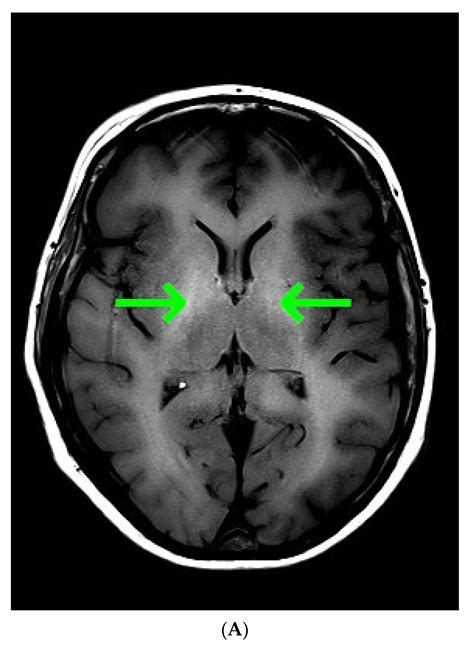 Diagnostics | Free Full-Text | Hepatic Encephalopathy Confirmed by ...