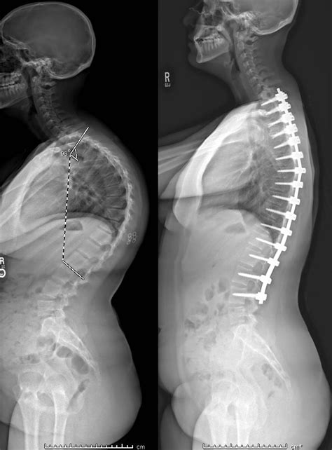 Adolescent Kyphosis | Scoliosis Texas